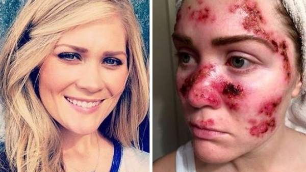 Alerta contra el abuso de los rayos UVA Alerta contra el abuso de los rayos UVA