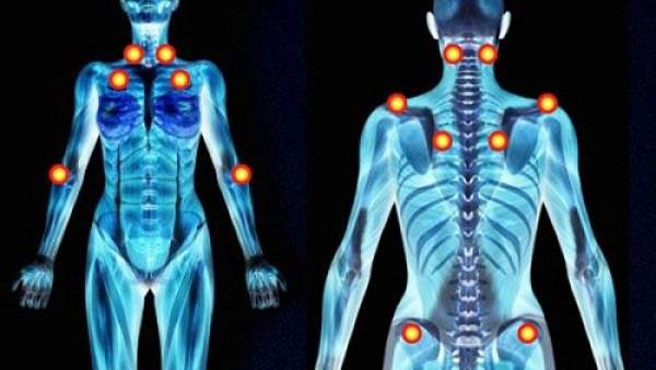 Fibromialgia Fibromialgia