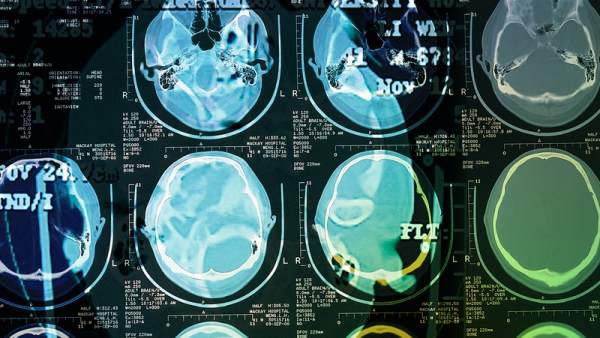 Cerebro Cerebro
