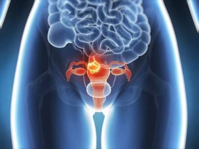 Endometriosis.