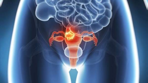 Resultado de imagen de endometriosis