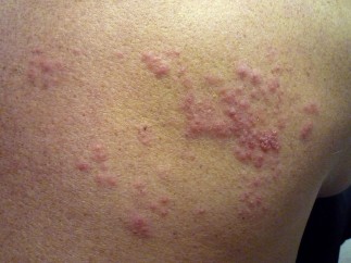 Herpes Zóster