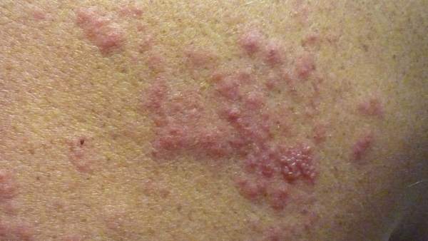 Resultado de imagen para herpes zoster licencia cc