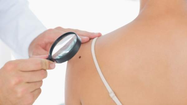 Lunares, cáncer de piel, melanoma Lunares, cáncer de piel, melanoma