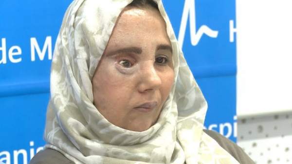 Samira ha recuperado su rostro tras tres intervencione en el Hospital de Manises Samira ha recuperado su rostro tras tres intervencione en el Hospital de Manises