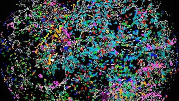 Imagen de recurso de un tumor Imagen de recurso de un tumor