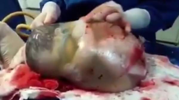 Bebé nace dentro de la bolsa amniótica Bebé nace dentro de la bolsa amniótica
