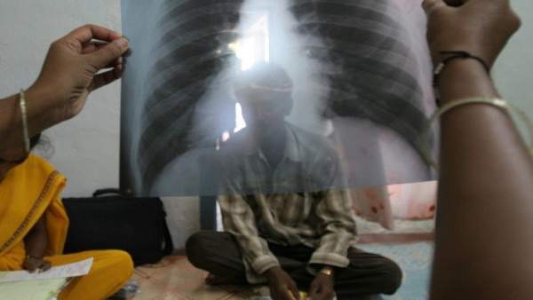 Tuberculosis Tuberculosis