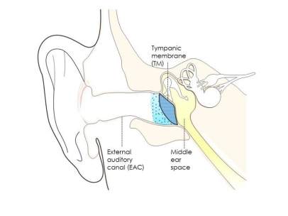 Otitis