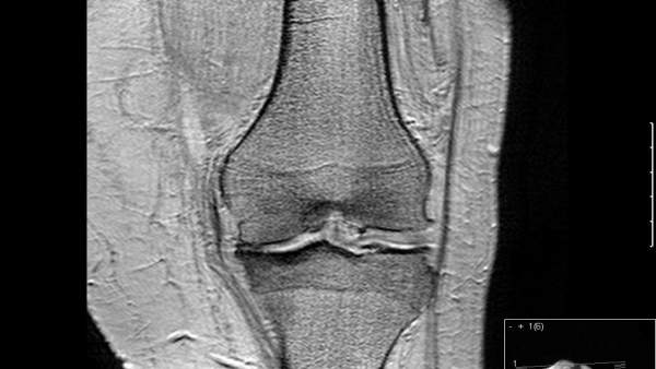 Artrosis de rodilla Artrosis de rodilla