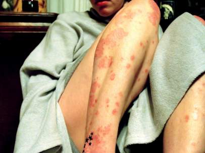 Dermatitis