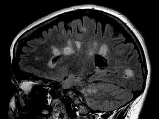 Cicatrización del cerebro en la esclerosis múltiple