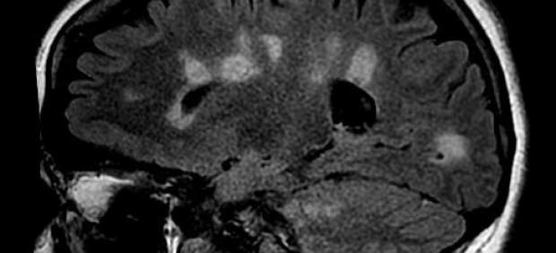 Cicatrización del cerebro en la esclerosis múltiple