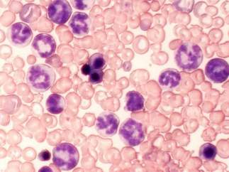 Células resistentes al tratamiento leucemia mieloide crónica (LMC) en ratón.