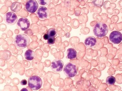 Células resistentes al tratamiento leucemia mieloide crónica (LMC) en ratón.
