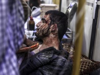 Herido en un bombardeo en Siria