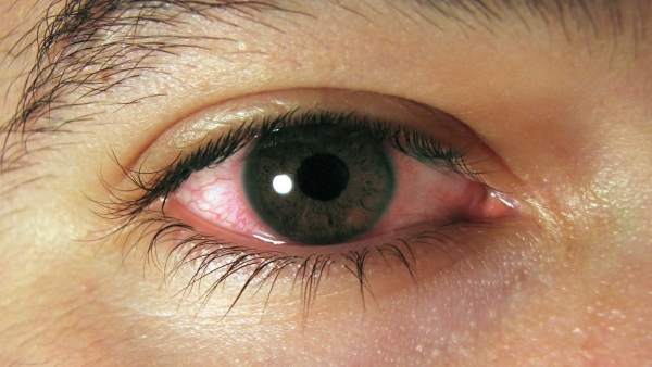 Ojo con conjuntivitis Ojo con conjuntivitis