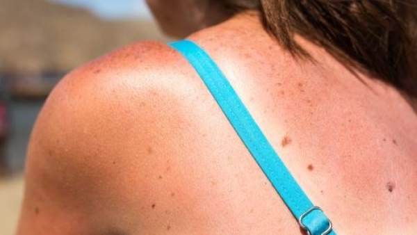 Bronceado Bronceado