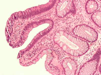 Cáncer de colon
