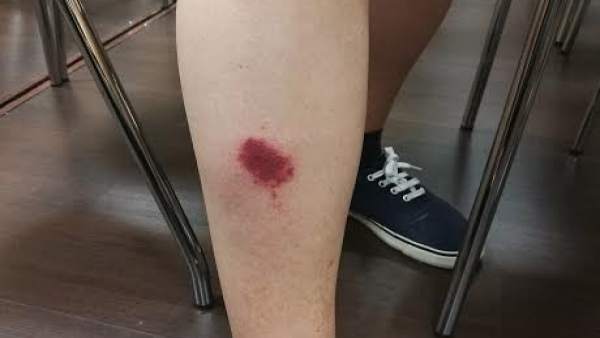 Mordisco de mosca negra Mordisco de mosca negra