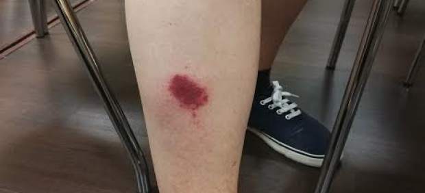 Mordisco de mosca negra