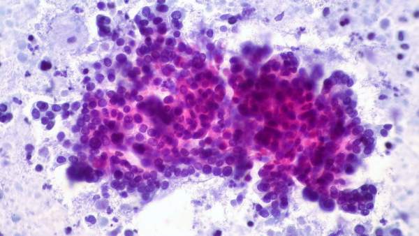 Cáncer de páncreas Cáncer de páncreas