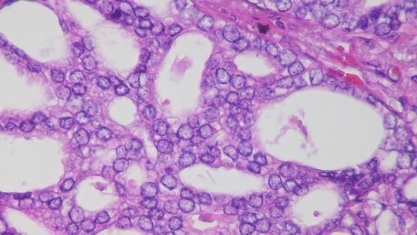 Metastasis de cáncer de prostata Metastasis de cáncer de prostata