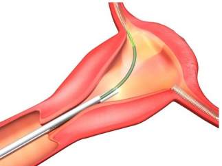 Essure