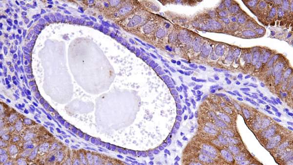 Cáncer de endometrio Cáncer de endometrio