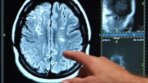 Derrame cerebral Derrame cerebral