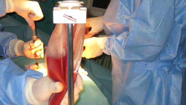 Técnica de extracción de médula ósea en quirófano Técnica de extracción de médula ósea en quirófano