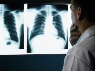 Cáncer de pulmón