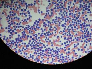 Leucemia