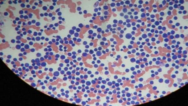 Leucemia Leucemia
