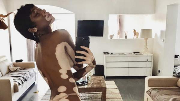 Winnie Harlow Winnie Harlow