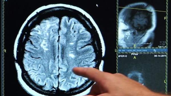 Ictus, derrame cerebral, cerebro Ictus, derrame cerebral, cerebro