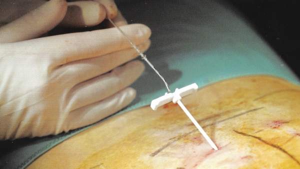 Neuromodulación de las raíces sacras para tratar la incontinencia fecal Neuromodulación de las raíces sacras para tratar la incontinencia fecal