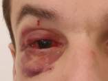 Imagen del guardia urbano herido en el ojo por un grupo de manteros en Barcelona.
