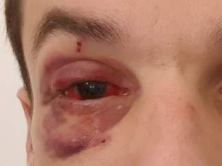 Imagen del guardia urbano herido en el ojo por un grupo de manteros en Barcelona.