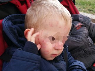 Daños sufridos por un niño en una guardería