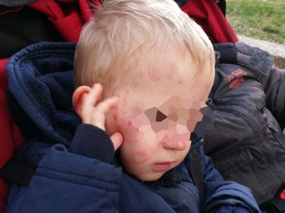 Daños sufridos por un niño en una guardería