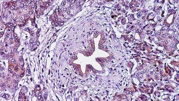 Adenocarcinoma ductal pancreático, cáncer páncreas Adenocarcinoma ductal pancreático, cáncer páncreas
