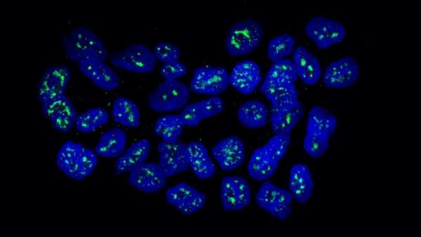 células metastásicas de cáncer de mama células metastásicas de cáncer de mama
