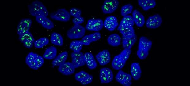 células metastásicas de cáncer de mama