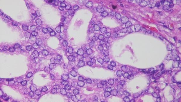 Metastasis de cáncer de prostata Metastasis de cáncer de prostata