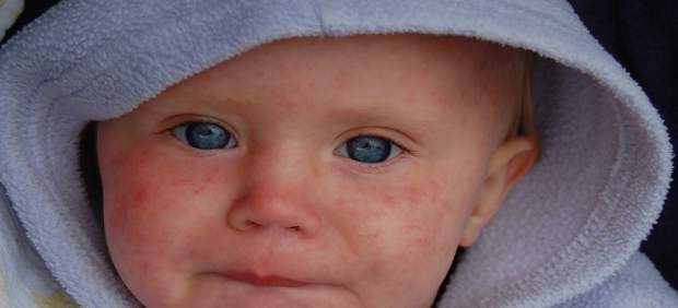 Niño con sarampión