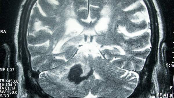Derrame cerebral Derrame cerebral