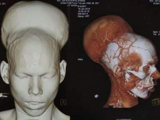 Tumor
