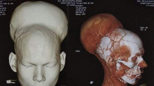 Tumor Tumor