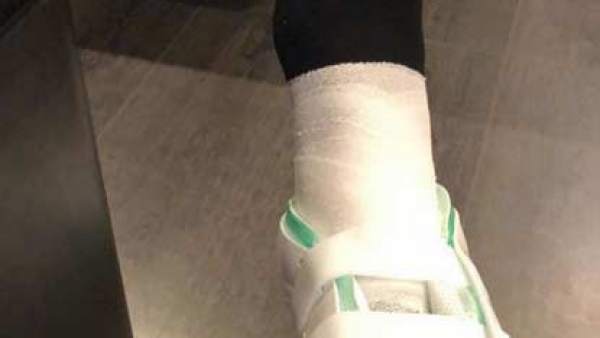Tobillo de Neymar Tobillo de Neymar